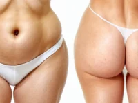 ¿Qué es la Liposucción de Pubis o Monte de Venus? Guía Completa